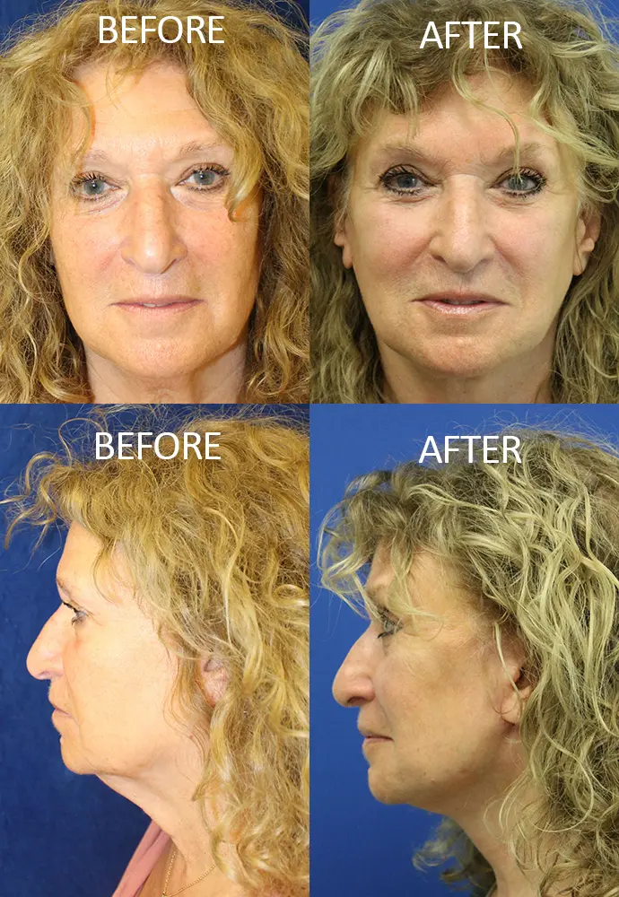 Face & Neck Lift