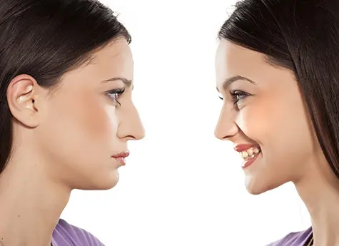 Rhinoplasty Procedure