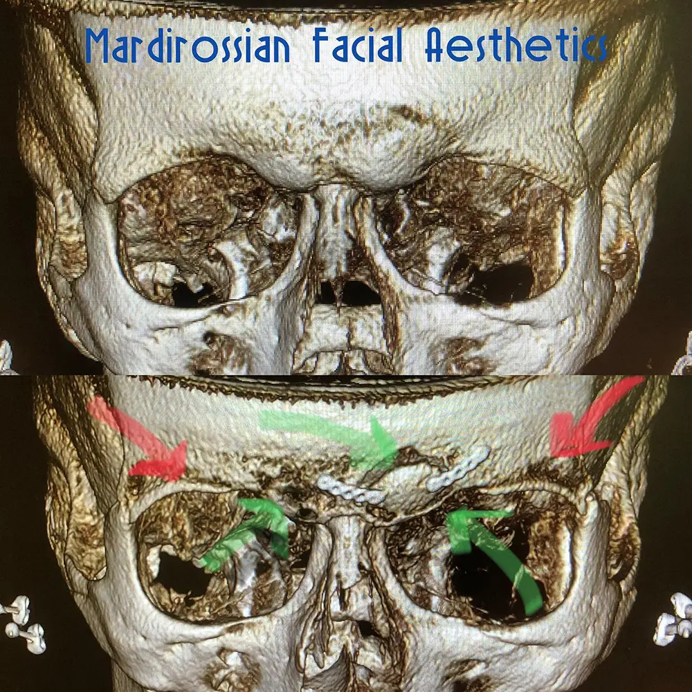 Forehead Contouring in McLean, VA